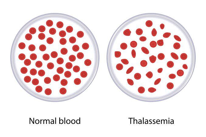 تالاسمی Thalassemia