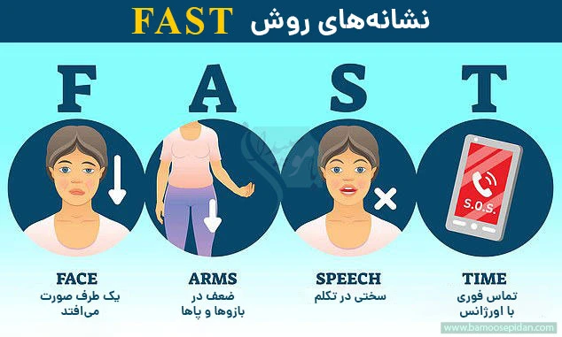 نشانه های روش fast سکته مغزی