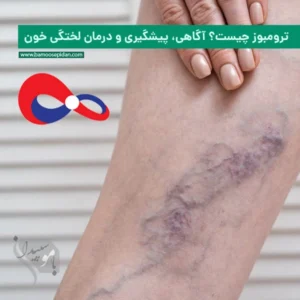 ترومبوز چیست؟ آگاهی، پیشگیری و درمان لختگی خون