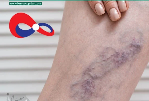 ترومبوز چیست؟ آگاهی، پیشگیری و درمان لختگی خون