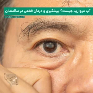 آب مروارید چیست؟ پیشگیری و درمان قطعی در سالمندان