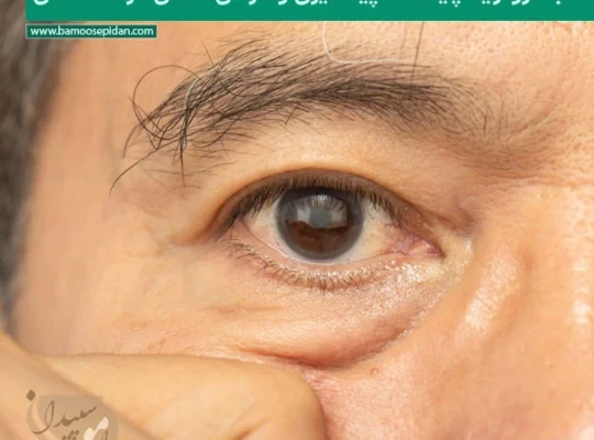 آب مروارید چیست؟ پیشگیری و درمان قطعی در سالمندان