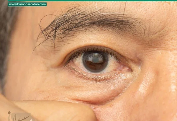 آب مروارید چیست؟ پیشگیری و درمان قطعی در سالمندان